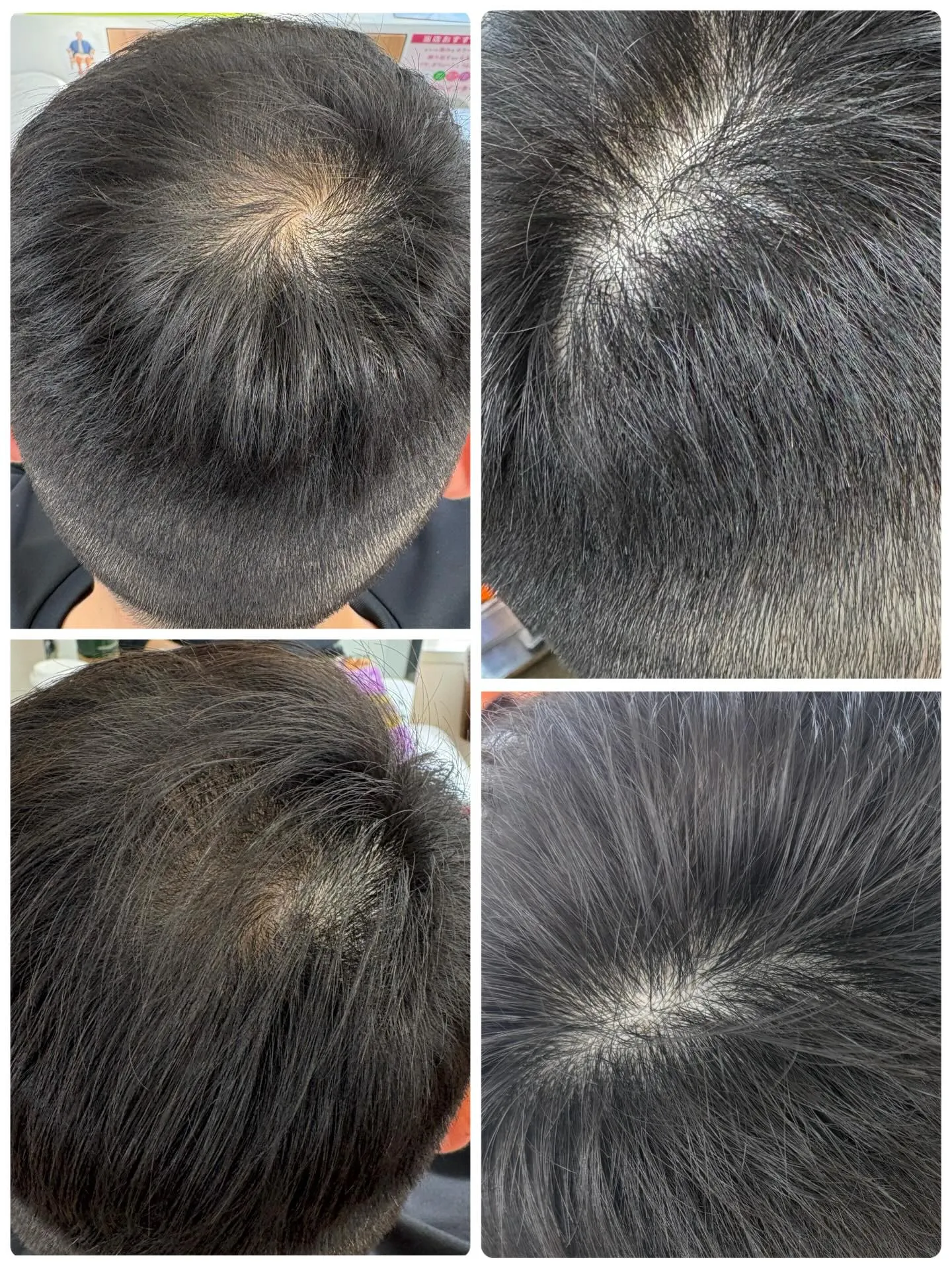 ヒト幹細胞発毛 HSC強髪